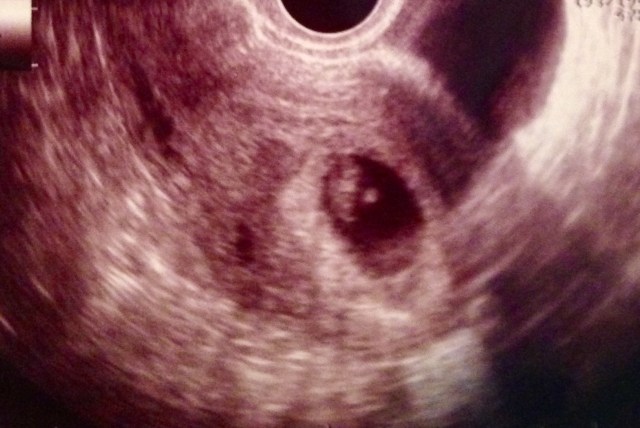 ultrasound1